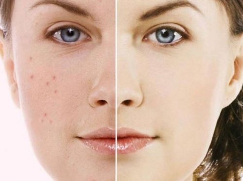 [Alhimik School] Жирная кожа (Наталия Ткаченко)