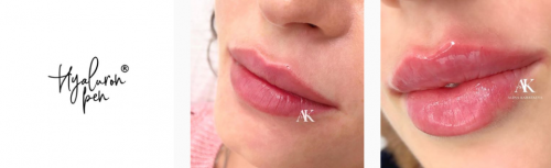 Полный курс Hyaluron Pen (гиалурон пен) Все методики контурной пластики (Алина Каратаева)