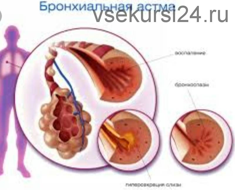 Лечение бронхиальной астмы (Александр Черепанов)