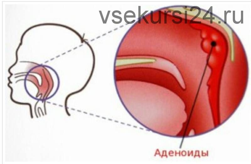 Аденоиды казнить нельзя помиловать (Елена Леднева)