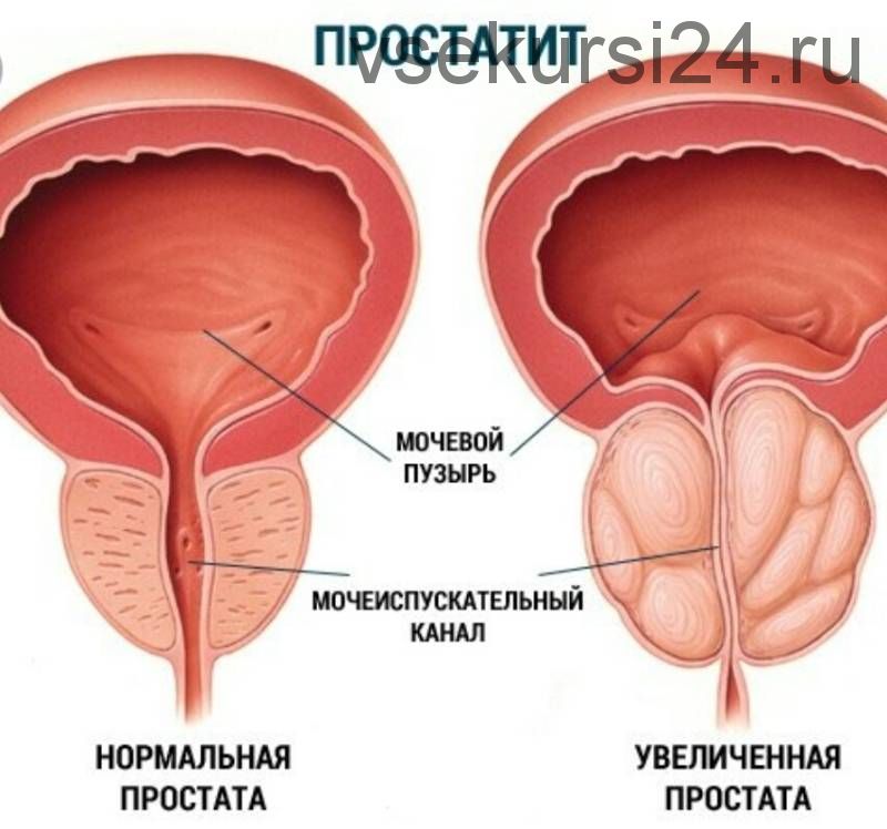 Как вылечить простатит