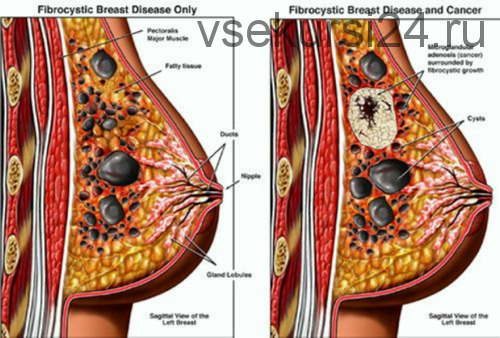Остеопатическое лечение фиброзно-кистозной мастопатии (Игорь Атрощенко)