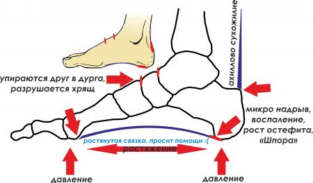 Стельки при пяточной шпоре