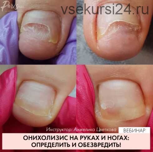 Вебинар 'Онихолизис : методы обработки' август 2019 (Карина Шурыгина)