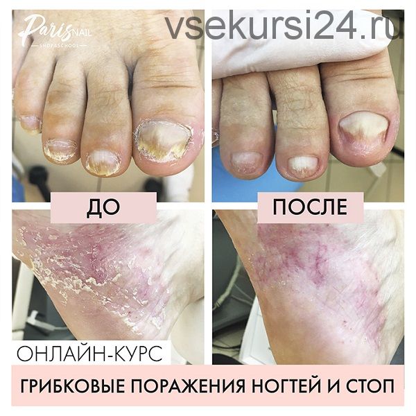 [parisnail] Грибковое поражение ногтей и кожи стоп (Карина Шурыгина)