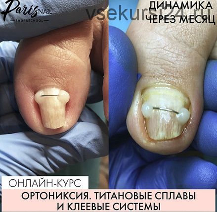 [ParisNail] Ортониксия. Титановые сплавы и клеевые системы (Карина Шурыгина)