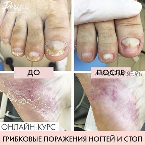 [parisnail] Грибковое поражение ногтей и кожи стоп (Карина Шурыгина)